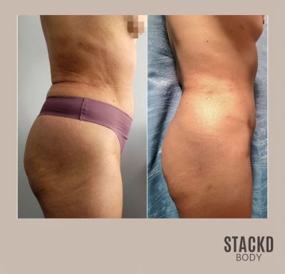 Abdominoplasty + Lipo360