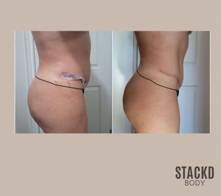 Abdominoplasty + Lipo