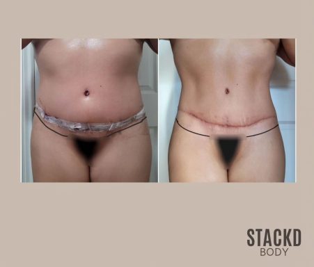 Abdominoplasty + Lipo