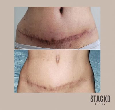 Abdominoplasty Scar