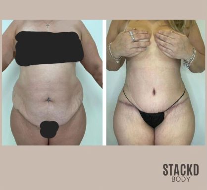 Abdominoplasty + Lipo360